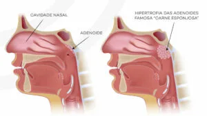 cirurgia para a remoção do tecido adenoidiano ou tonsila faríngea