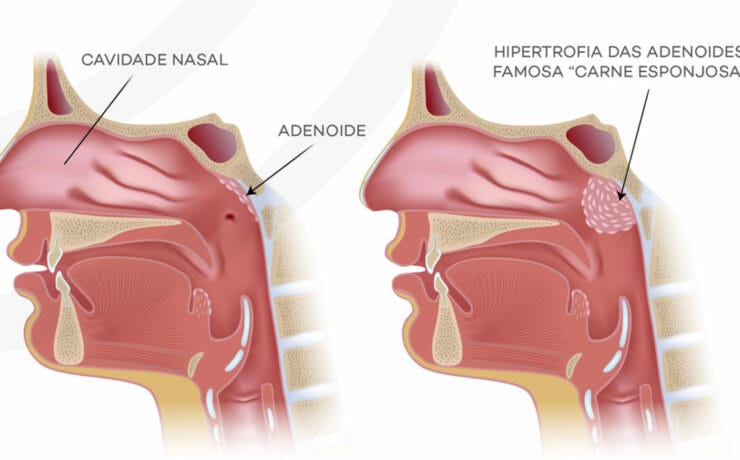 cirurgia para a remoção do tecido adenoidiano ou tonsila faríngea